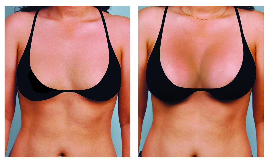 Breast augmentation lincoln ne