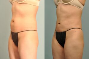 smartlipo-before-after-LA