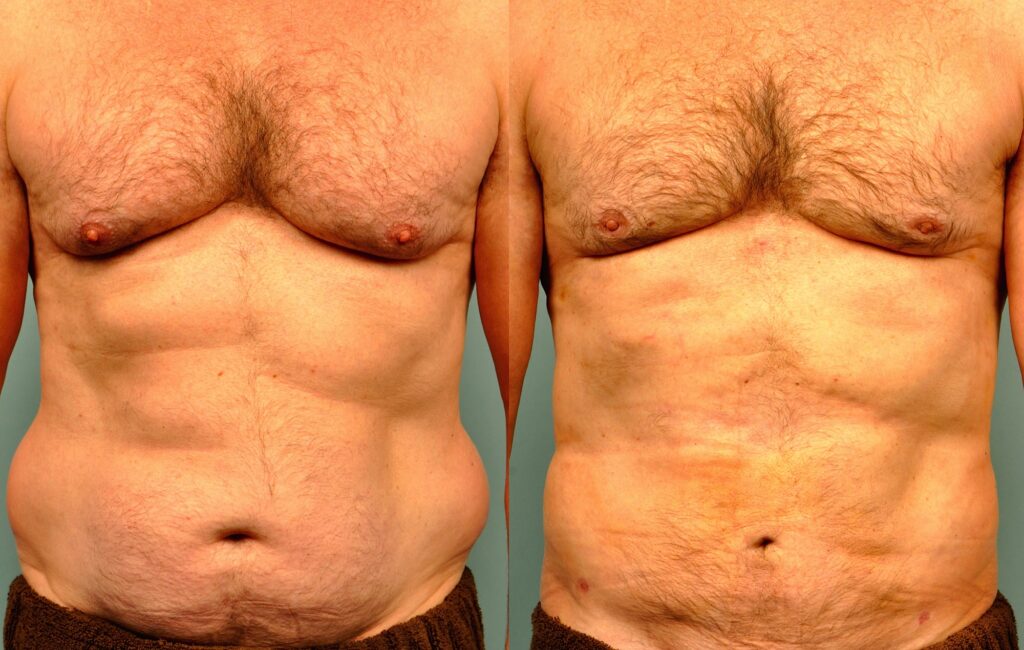 Male SmartLipo