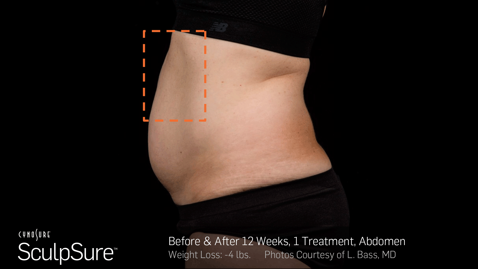 BA-SculpSure-LBass-12Wks-1Tx-05