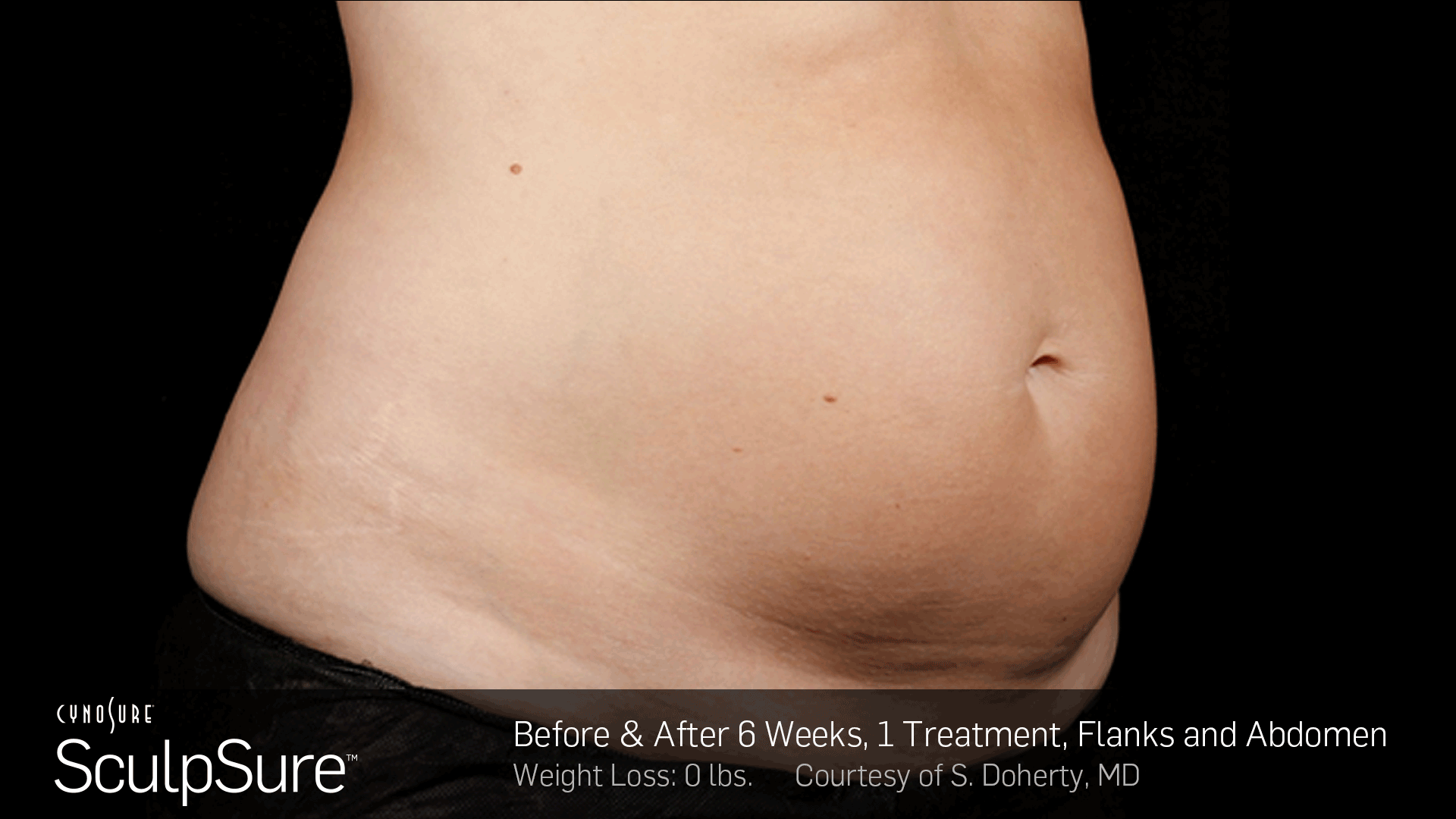BA-SculpSure-SDoherty-6Wks-1Tx-01