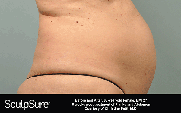 NM--SculpSure-6-weeks-bannerinfo