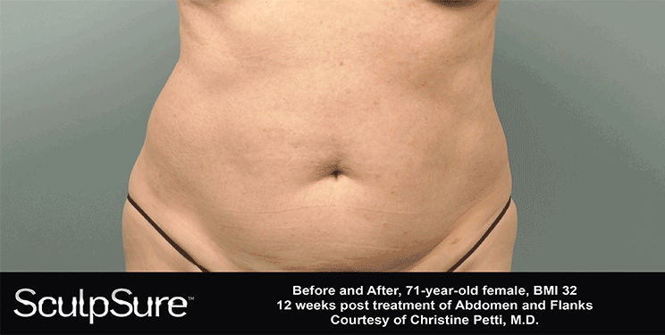 PW---Front--gif--sculpsure-banner