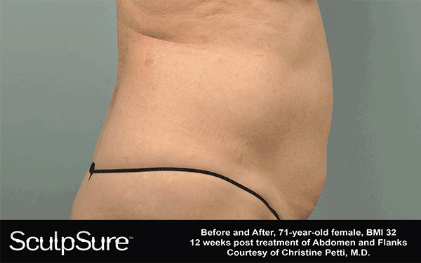 PW---SIDE--Gif-6-weeks-SculpSure---with-Banner