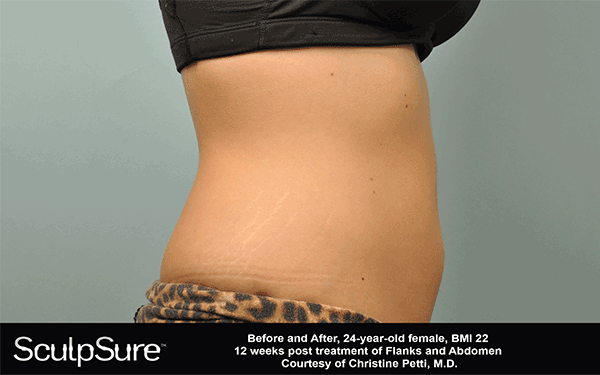 am-sculpsure-12-weeks-out-with-banner