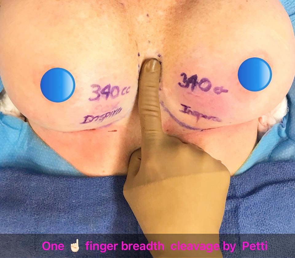https://www.dr-petti.com/wp-content/uploads/2018/01/One-Fingerbreadth-Cleavage.jpg
